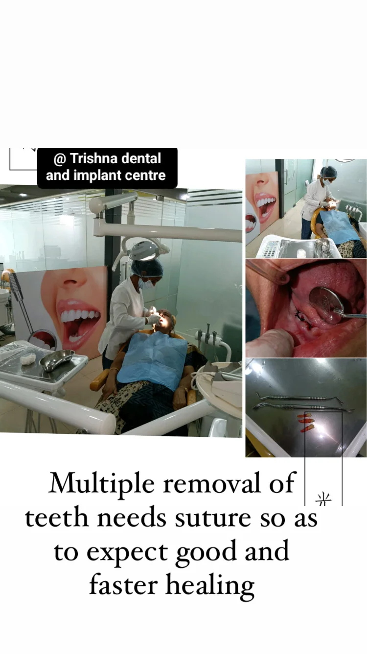 MULTIPLE TEETH REMOVAL
