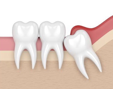 REMOVAL  OF PREGROWN TISSUES