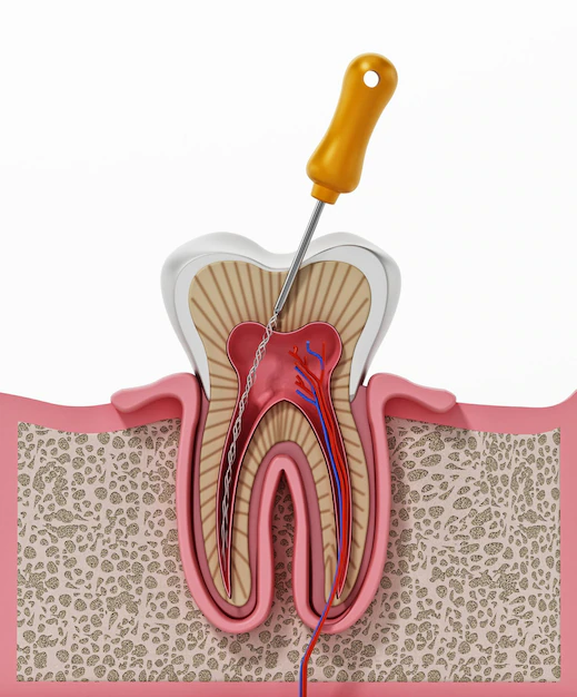 ROOTCANAL TREATMENT