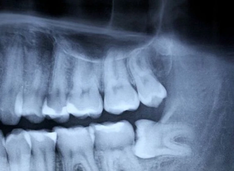 DENTAL XRAYS