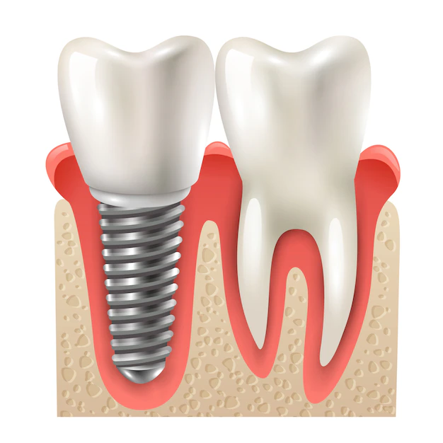 IMPLANTS PLACEMENT